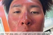 男子爬雪山晒伤成面膜脸 网友：户外登山一等要做好防护啊